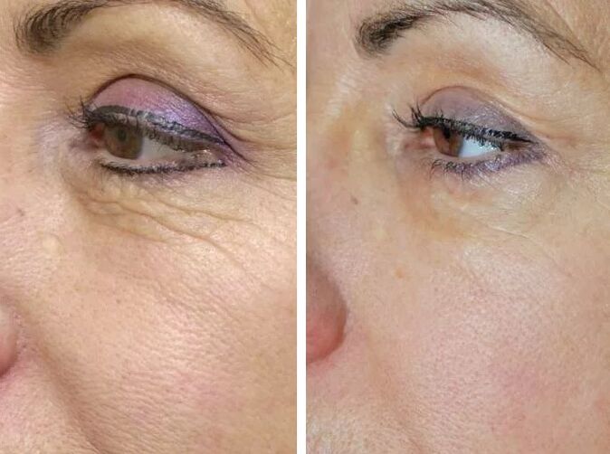 Πεδίο λέιζερ πριν και μετά