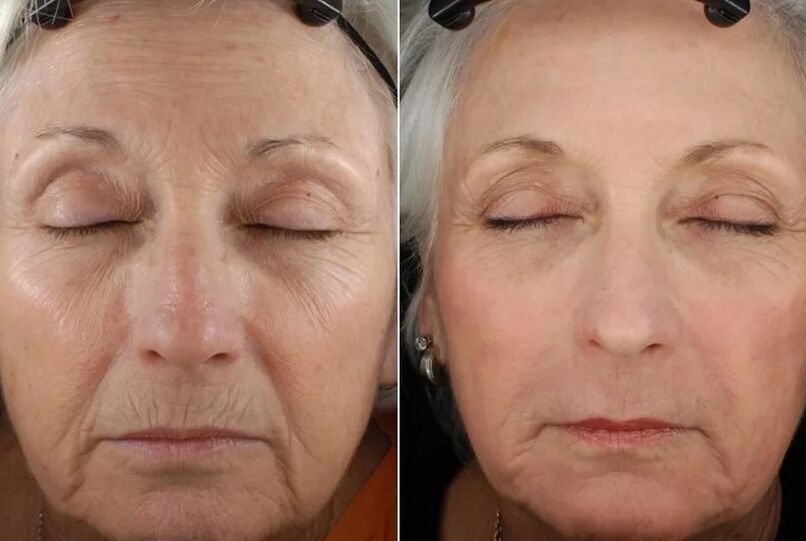 Τα αποτελέσματα της κλασματικής αναζωογόνησης