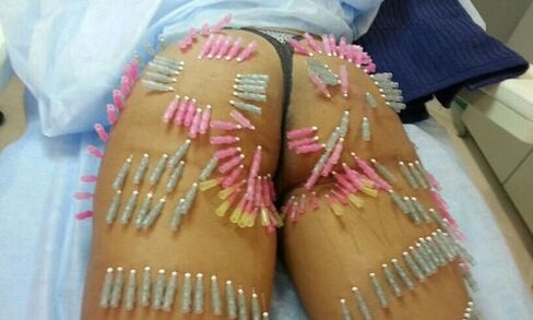 ανύψωση γλουτών